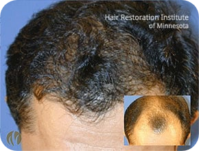 Hair Loss FAQ img1