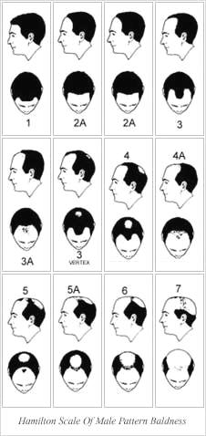 Mens Hair Loss Causes and Hair Replacements img