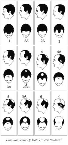 Hair Loss FAQ img3