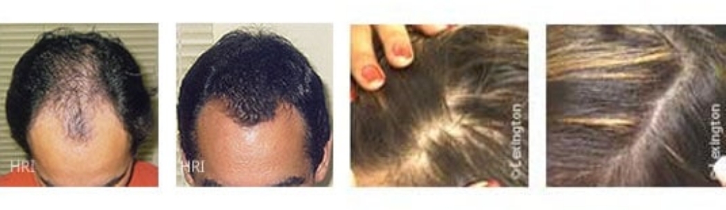 Proven Hair Loss Treatment img