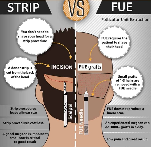 strip vs fue hair transplants