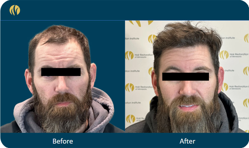 HRI patient before and after