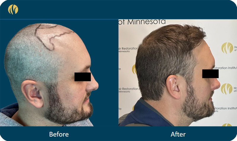 HRI patient before and after