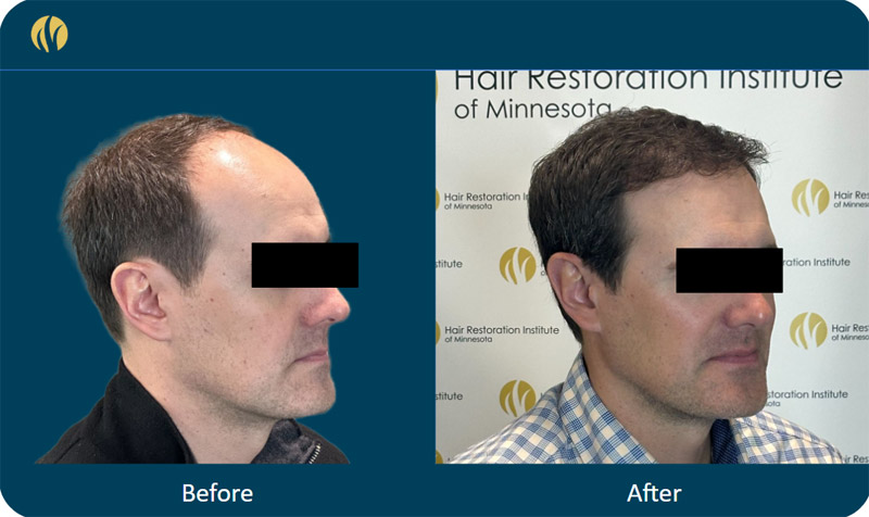 HRI patient before and after