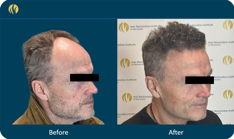HRI patient before and after