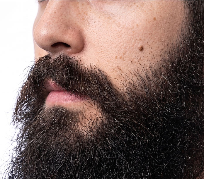 Beard transplant result