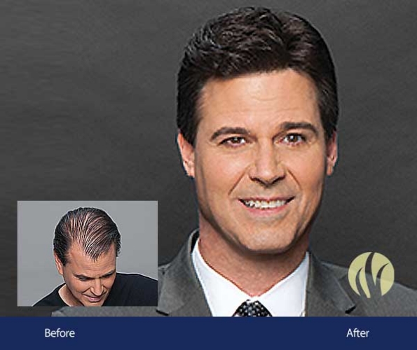 HairMetrix consultation for men with hair loss in Minnesota