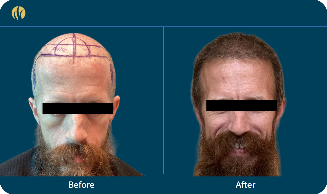 Brent — before and after hair transplant