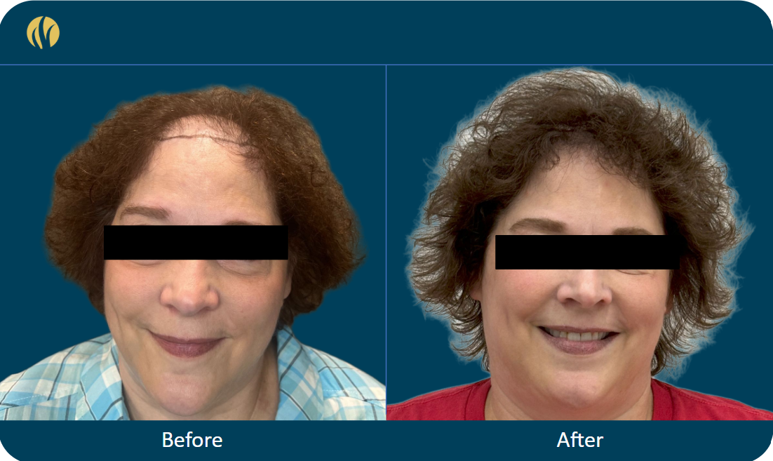 Carol — before and after hair transplant