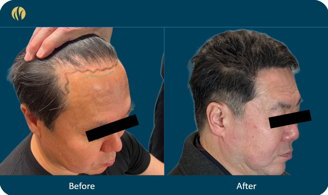 Saitō — before and after hair transplant