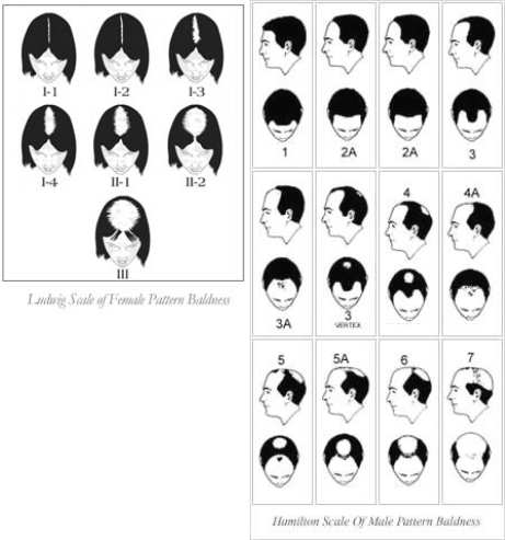 Ludwig's Scale for Women - Use Ludwigs Scale Chart For Hair Loss