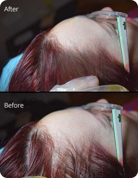 Scalp Micropigmentation Work img1