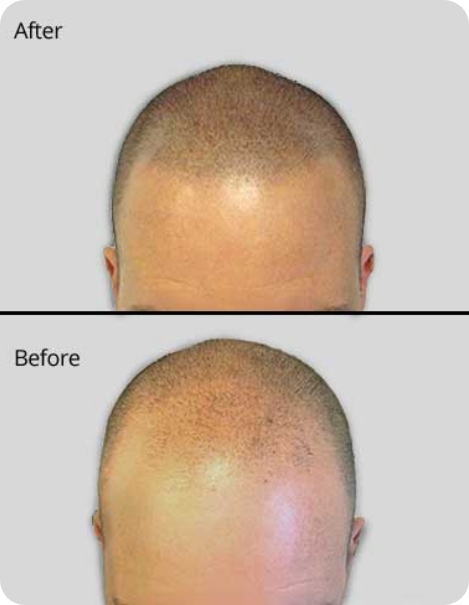 calp Micropigmentation A Scalp Tattoo img