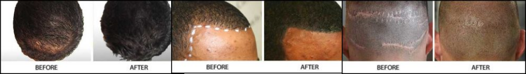 Scalp Micropigmentation img